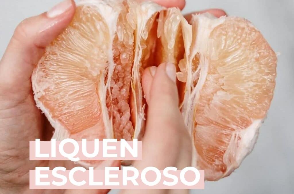 Liquen escleroso vulvar: qué es, síntomas y cómo tratarlo en menopausia